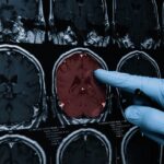 Muere a los 24 años la persona más joven en ser diagnosticada de Alzheimer en Reino Unido: su cerebro era el de una persona de 70 años